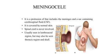 MENINGOCELE
• It is a protrusion of that includes the meninges and a sac containing
cerebrospinal fluid (CSF).
• It is covered by normal skin.
• Spinal cord is never involved.
• Usually seen in lumbosacral
region, but may also be seen
thoracic region and skull.
 