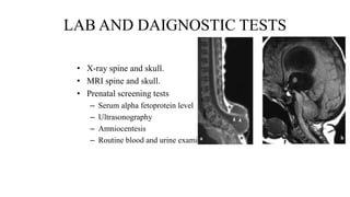 LAB AND DAIGNOSTIC TESTS
• X-ray spine and skull.
• MRI spine and skull.
• Prenatal screening tests
– Serum alpha fetoprotein level
– Ultrasonography
– Amniocentesis
– Routine blood and urine examination
 