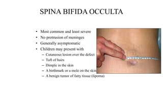 Spina bifida | PPT