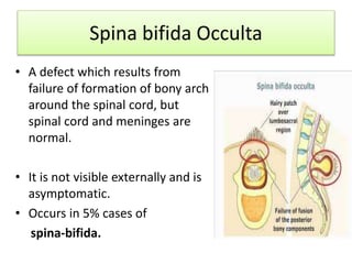 Spina bifida Occulta
• A defect which results from
failure of formation of bony arch
around the spinal cord, but
spinal cord and meninges are
normal.
• It is not visible externally and is
asymptomatic.
• Occurs in 5% cases of
spina-bifida.
 