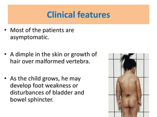 Clinical features
• Most of the patients are
asymptomatic.
• A dimple in the skin or growth of
hair over malformed vertebra.
• As the child grows, he may
develop foot weakness or
disturbances of bladder and
bowel sphincter.
 