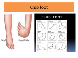 Club foot
 