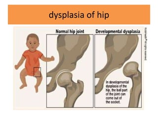 dysplasia of hip
 