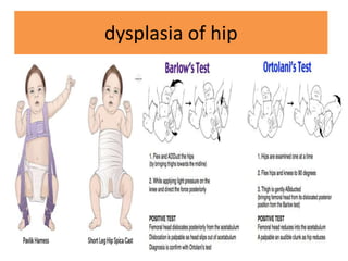 dysplasia of hip
 