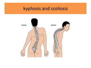 kyphosis and scoliosis
 