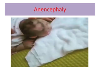 Anencephaly
 