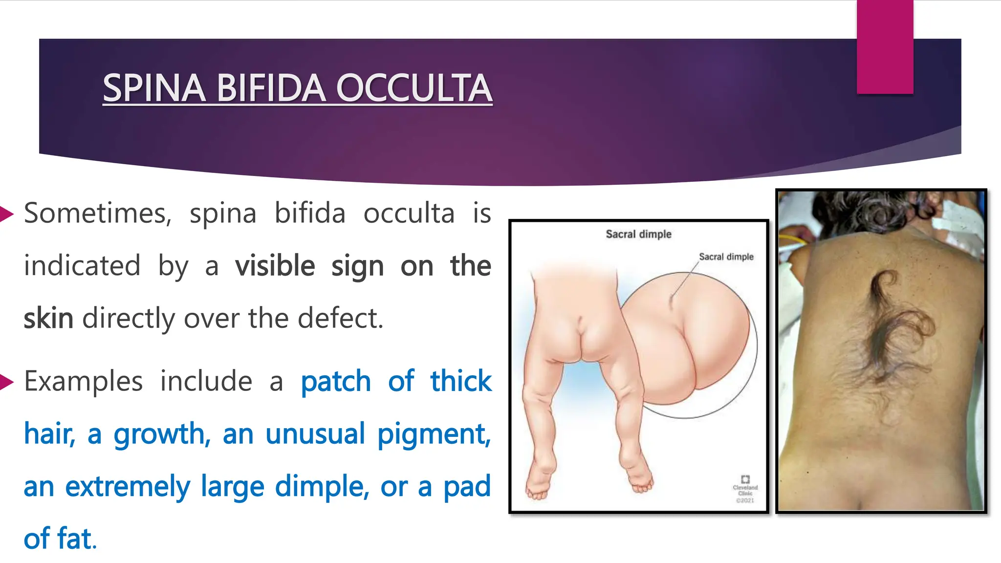 Spinal Defet spina bifida (neural tube defects) .pptx