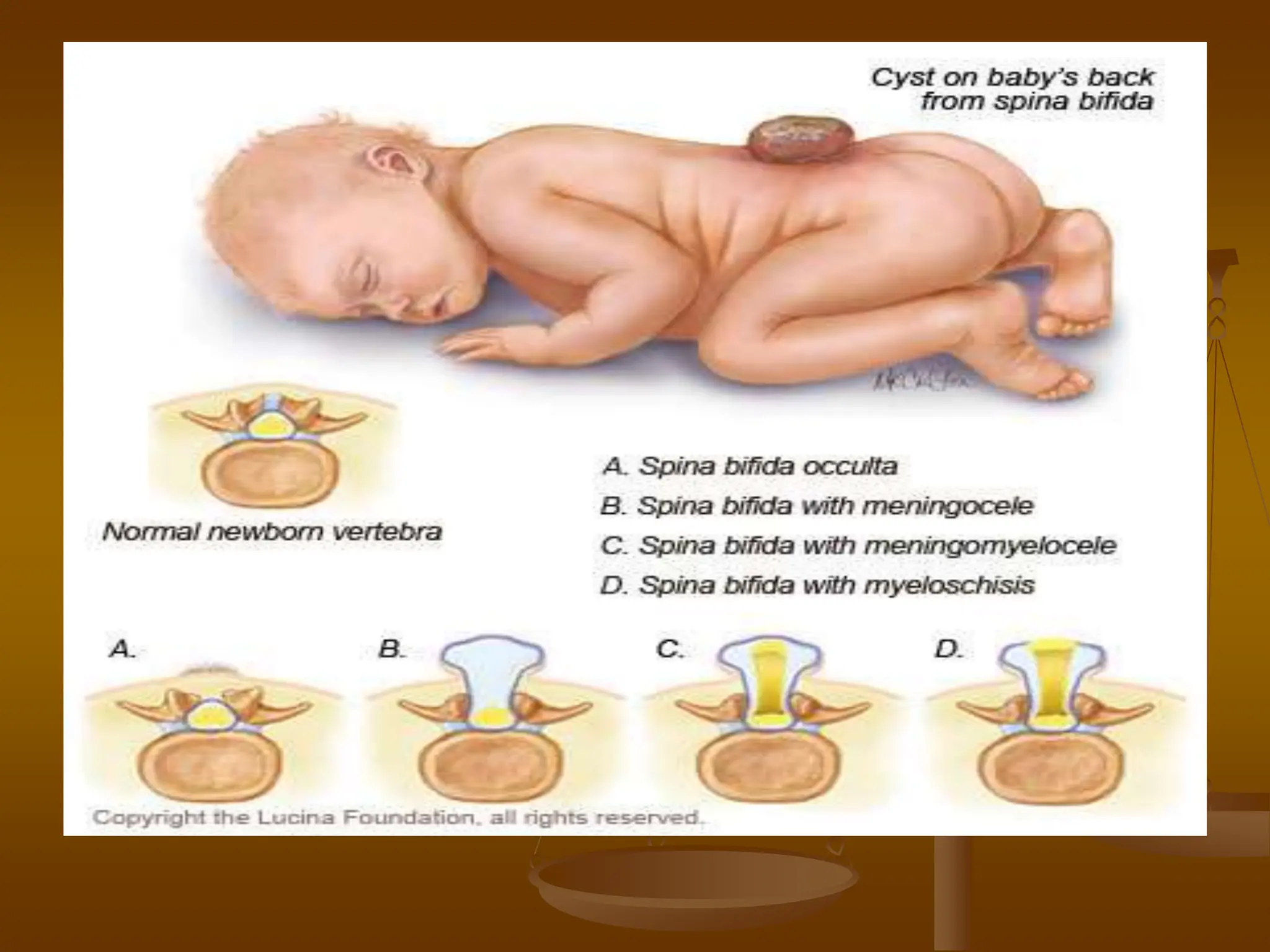 Spina Bifida Birth Defect Spinal Nerves Spinal Cord PPTX