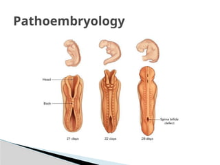 SPINA BIFIDA.pptx one of the neural tube defects | PPTX