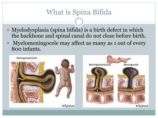What is Spina Bifida
 Myelodysplasia (spina bifida) is a birth defect in which
the backbone and spinal canal do not close before birth.
 Myelomeningocele may affect as many as 1 out of every
800 infants.
 