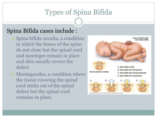 Types of Spina Bifida
Spina Bifida cases include :
 Spina bifida occulta, a condition
in which the bones of the spine
do not close but the spinal cord
and meninges remain in place
and skin usually covers the
defect
 Meningoceles, a condition where
the tissue covering the spinal
cord sticks out of the spinal
defect but the spinal cord
remains in place.
 