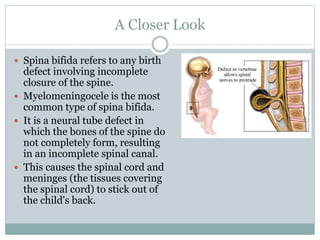 A Closer Look
 Spina bifida refers to any birth
defect involving incomplete
closure of the spine.
 Myelomeningocele is the most
common type of spina bifida.
 It is a neural tube defect in
which the bones of the spine do
not completely form, resulting
in an incomplete spinal canal.
 This causes the spinal cord and
meninges (the tissues covering
the spinal cord) to stick out of
the child's back.
 