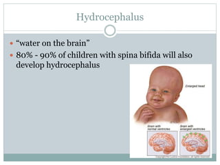 Hydrocephalus
 “water on the brain”
 80% - 90% of children with spina bifida will also
develop hydrocephalus
 