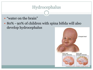 Hydrocephalus“water on the brain”80% - 90% of children with spina bifida will also develop hydrocephalus
