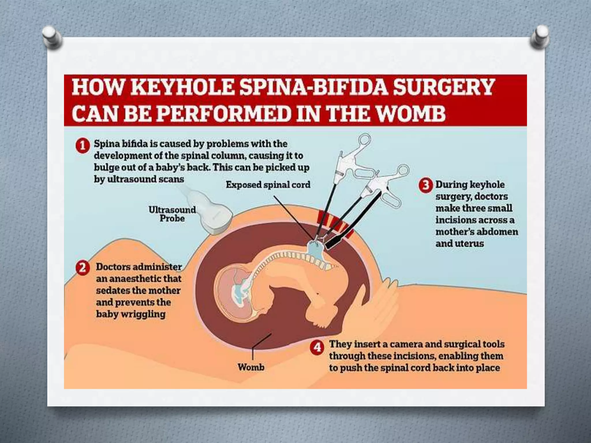 Spina bifida - Child Health Nursing | PPT