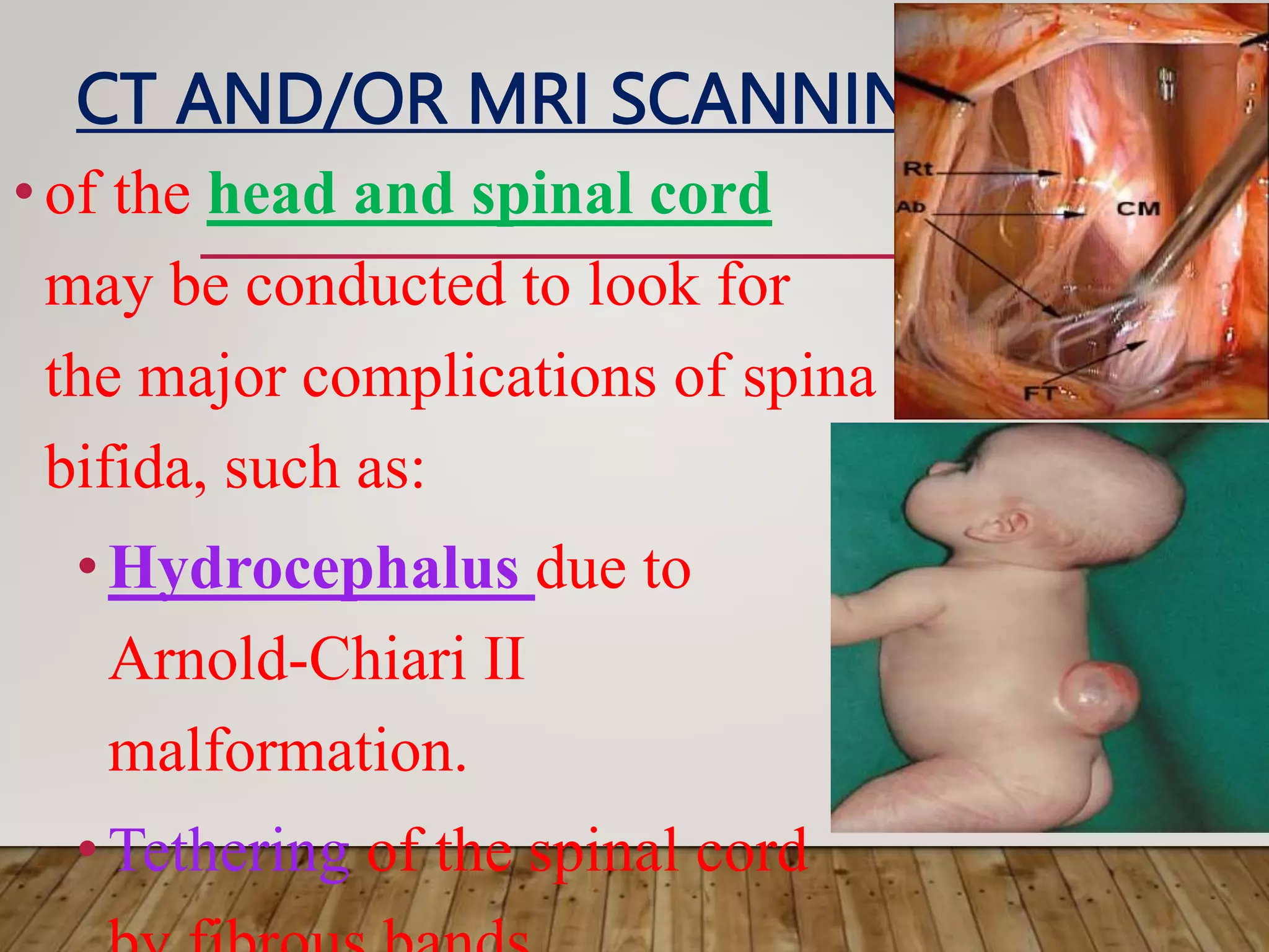 spina bifida and pt mangement [Autosaved].pptx
