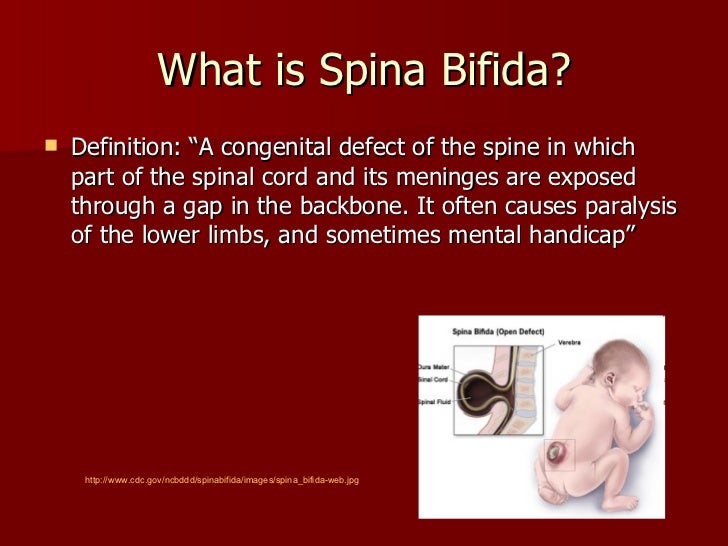 Spina bifida hi