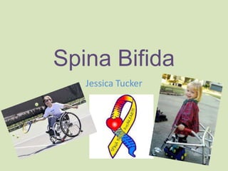 Spina Bifida
Jessica Tucker

 