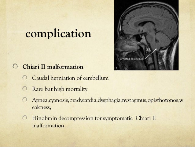 spina bifida myelomeningocele repair treatment and complications myelomeningocele repair