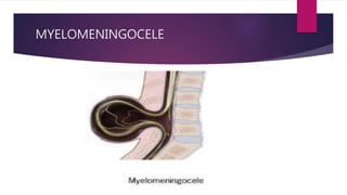 MYELOMENINGOCELE
 