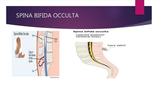 SPINA BIFIDA OCCULTA
 
