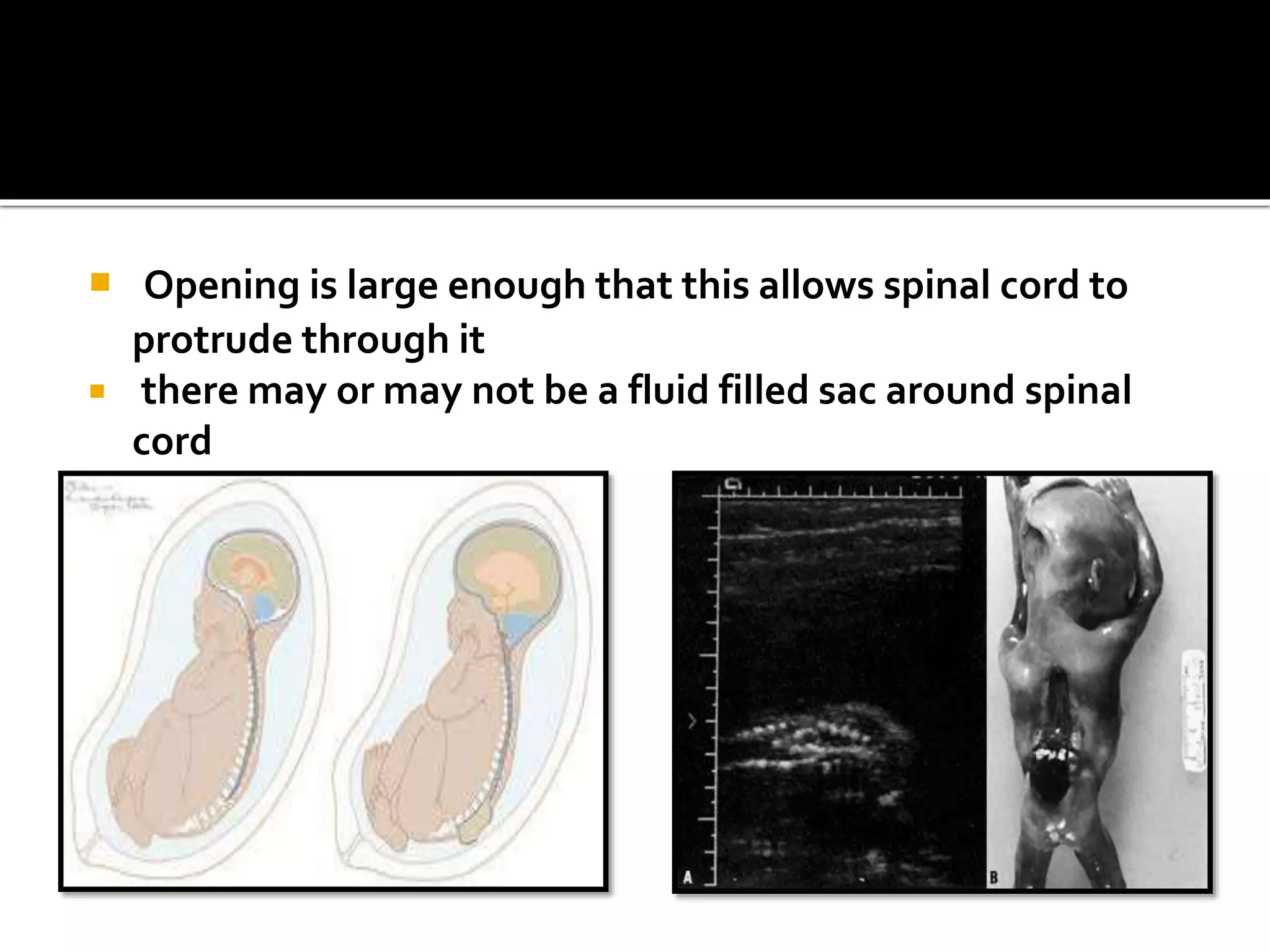 Spina bifida ppt | PPTX