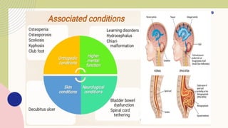 SPINA BIFIDA ppt.pptx upload powerpoint presentation | PPTX