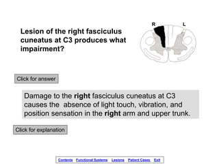 Lesion of the right fasciculus
cuneatus at C3 produces what
impairment?
Click for answer
Damage to the right fasciculus cu...