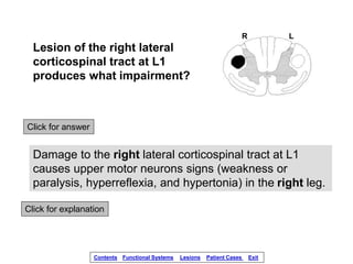 Lesion of the right lateral
corticospinal tract at L1
produces what impairment?
Click for answer
Damage to the right later...
