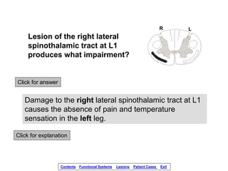 Click for answer
Damage to the right lateral spinothalamic tract at L1
causes the absence of pain and temperature
sensatio...