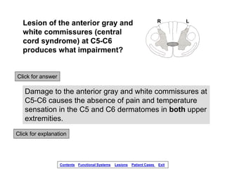 Click for answer
Damage to the anterior gray and white commissures at
C5-C6 causes the absence of pain and temperature
sen...