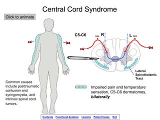 C5-C6
Central Cord Syndrome
Lateral
Spinothalamic
Tract
Impaired pain and temperature
sensation, C5-C6 dermatomes,
bilater...
