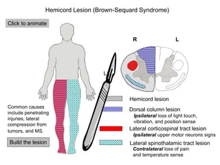 R L
Hemicord Lesion (Brown-Sequard Syndrome)
Dorsal column lesion
Ipsilateral loss of light touch,
vibration, and position...