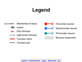 Legend
First-order neuron
Second-order neuron
Third-order neuron
Pain stimulus
Mechanism of injury
Lesion
Sensory impairme...