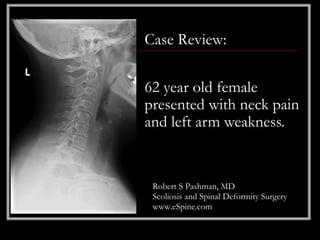 Case Review:

62 year old female
presented with neck pain
and left arm weakness.


 Robert S Pashman, MD
 Scoliosis and Spinal Deformity Surgery
 www.eSpine.com
 