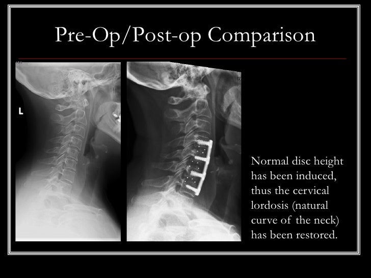 Case Review #8: 62 year old female with cervical spinal stenosis