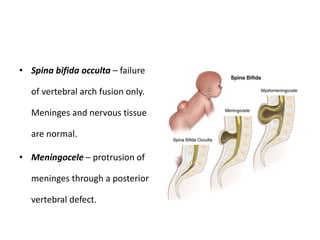 • Spina bifida occulta – failure
of vertebral arch fusion only.
Meninges and nervous tissue
are normal.
• Meningocele – protrusion of
meninges through a posterior
vertebral defect.
 