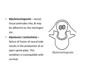 • Myelomeningocele – neural
tissue protrudes into, & may
be adherent to, the meningeal
sac.
• Myelocele ( rachischisis) –
failure of fusion of neural tube
results in the production of an
open spinal plate. This
condition is incompatible with
survival.
 