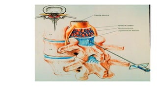 Spinal anaesthesia  basics