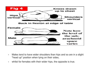 • Males tend to have wider shoulders than hips and so are in a slight
"head up" position when lying on their sides,
• whilst for females with their wider hips, the opposite is true.
 