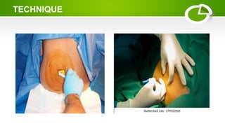 spinal anesthesia ........................................ | PPT