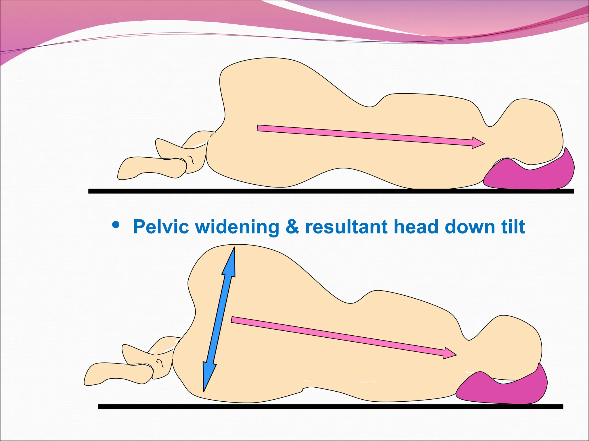  Pelvic widening & resultant head down tilt
 