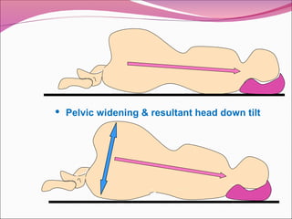  Pelvic widening & resultant head down tilt
 