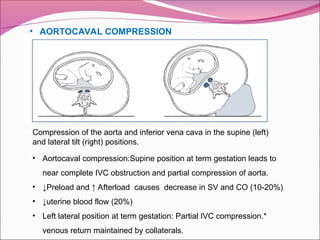 • AORTOCAVAL COMPRESSION
Compression of the aorta and inferior vena cava in the supine (left)
and lateral tilt (right) positions.
• Aortocaval compression:Supine position at term gestation leads to
near complete IVC obstruction and partial compression of aorta.
• ↓Preload and ↑ Afterload causes decrease in SV and CO (10-20%)
• ↓uterine blood flow (20%)
• Left lateral position at term gestation: Partial IVC compression.*
venous return maintained by collaterals.
 