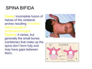 Spinal Defet spinal anomalies- 1.pptx44444444444444444 | PPTX