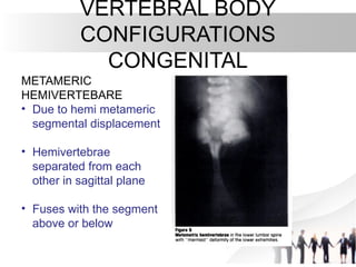 Metameric Body spinal anomalies- 1.pptx44444444444444444 | PPTX