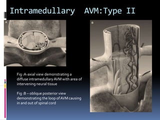 Spinal AVM AIIMS.pptx