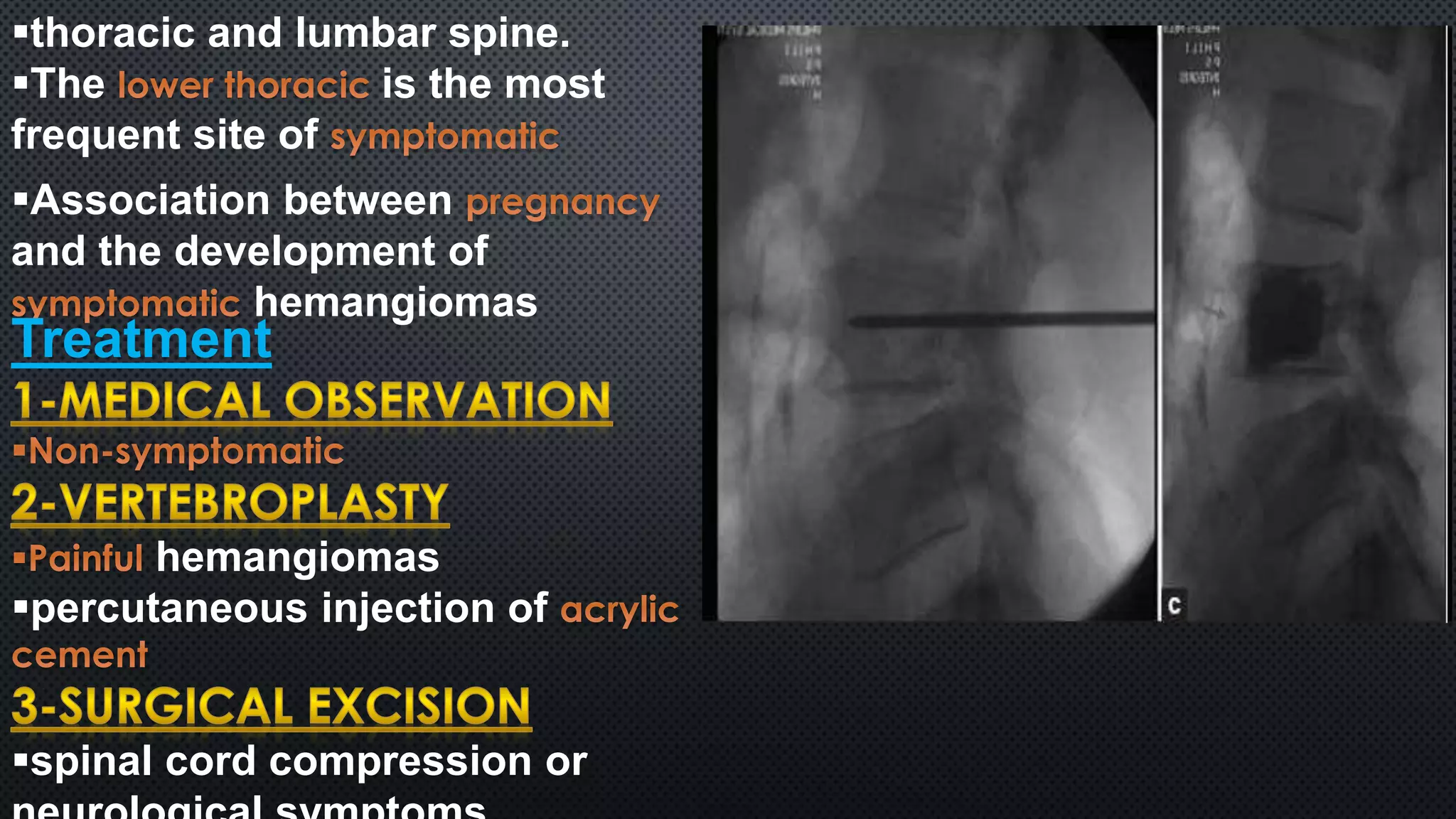 thoracic and lumbar spine. 
The is the most 
frequent site of 
Association between 
and the development of 
hemangiomas 
Treatment 
hemangiomas 
percutaneous injection of 
spinal cord compression or 
neurological symptoms 
 
