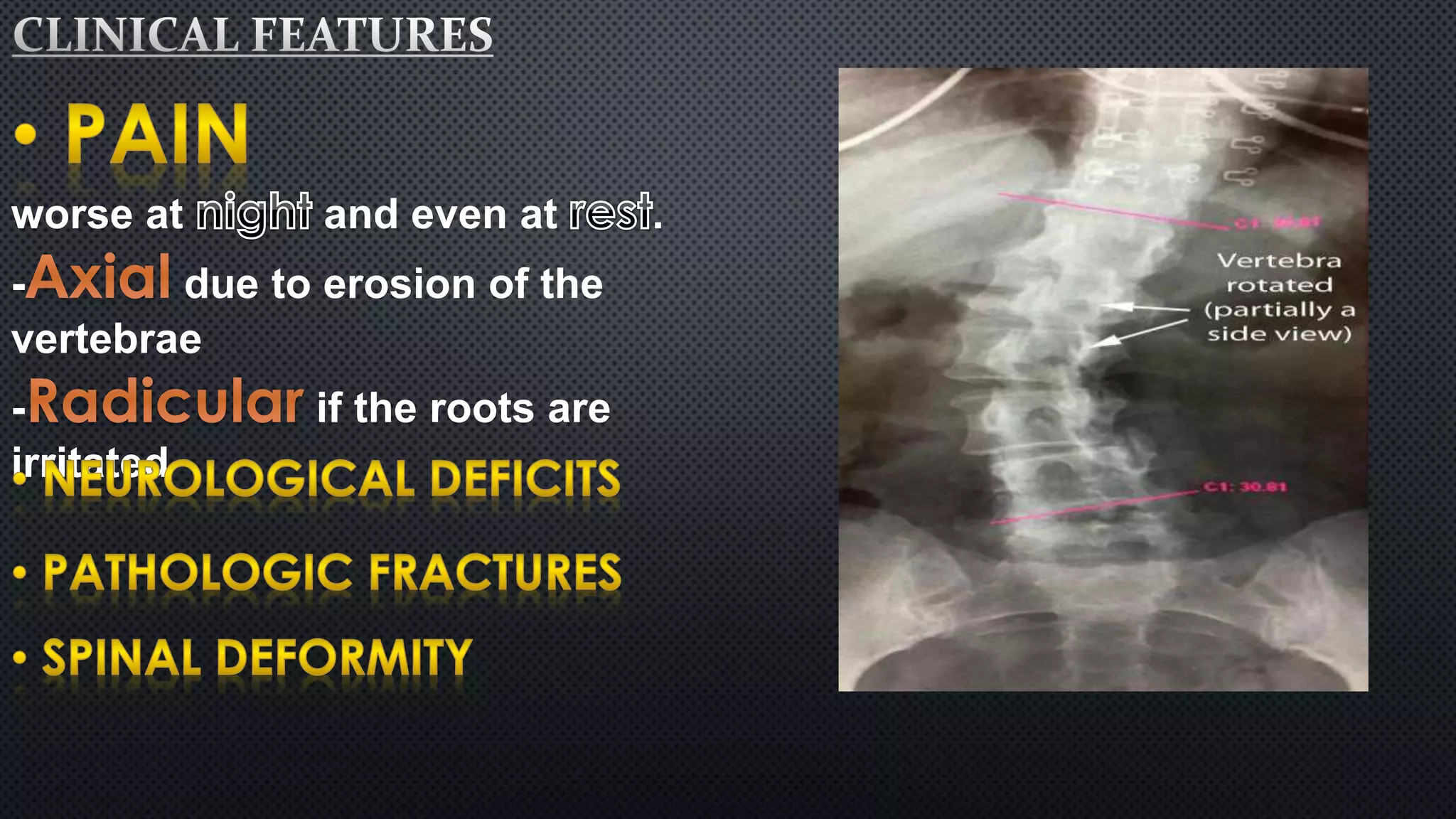 worse at and even at . 
- due to erosion of the 
vertebrae 
- if the roots are 
irritated 
 