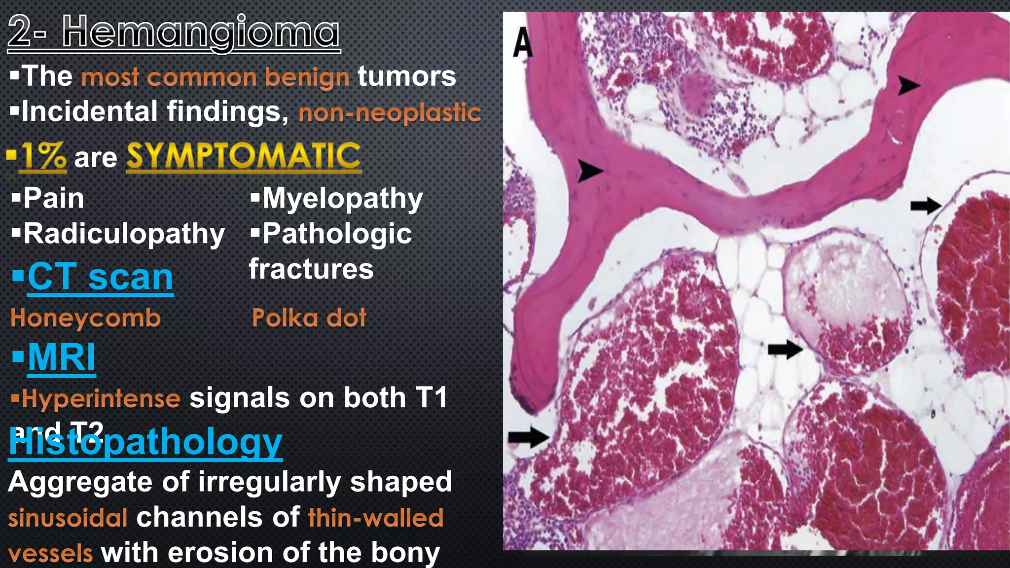 The tumors 
Incidental findings, 
are 
Myelopathy 
Pathologic 
fractures 
Pain 
Radiculopathy 
CT scan 
MRI 
signals on both T1 
Hanids tTo2pathology 
Aggregate of irregularly shaped 
channels of 
with erosion of the bony 
 